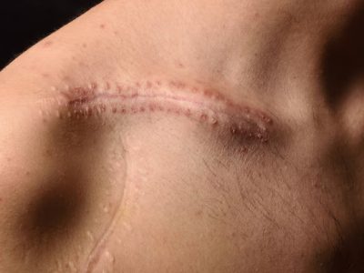 Keloid Sebuah Jaringan Parut Yang Berkembang Di Area Kulit