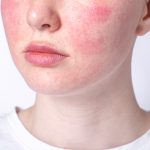 Penyakit Rosacea, Kenali Gejala, Penyebab Dan Pengobatannya