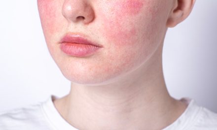 Penyakit Rosacea, Kenali Gejala, Penyebab Dan Pengobatannya