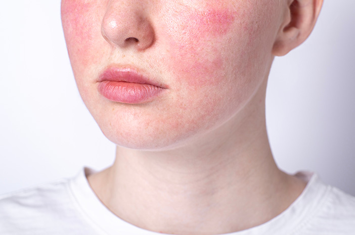 Penyakit Rosacea, Kenali Gejala, Penyebab Dan Pengobatannya