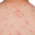 Penyakit Cacar Air Kenali Gejala Dan Cara Pengobatannya