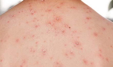 Penyakit Cacar Air Kenali Gejala Dan Cara Pengobatannya