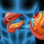 Vipoma, Tumor Langka yang Menyebabkan Diare Parah