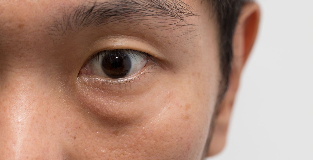 Pengaruh Rhinitis Alergi Terhadap Kantong Mata