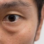 Pengaruh Rhinitis Alergi Terhadap Kantong Mata