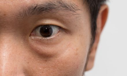 Pengaruh Rhinitis Alergi Terhadap Kantong Mata