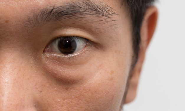 Pengaruh Rhinitis Alergi Terhadap Kantong Mata